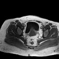 Benign seromucinous cystadenoma of the ovary (Radiopaedia 71065-81300 Axial T1 7).jpg