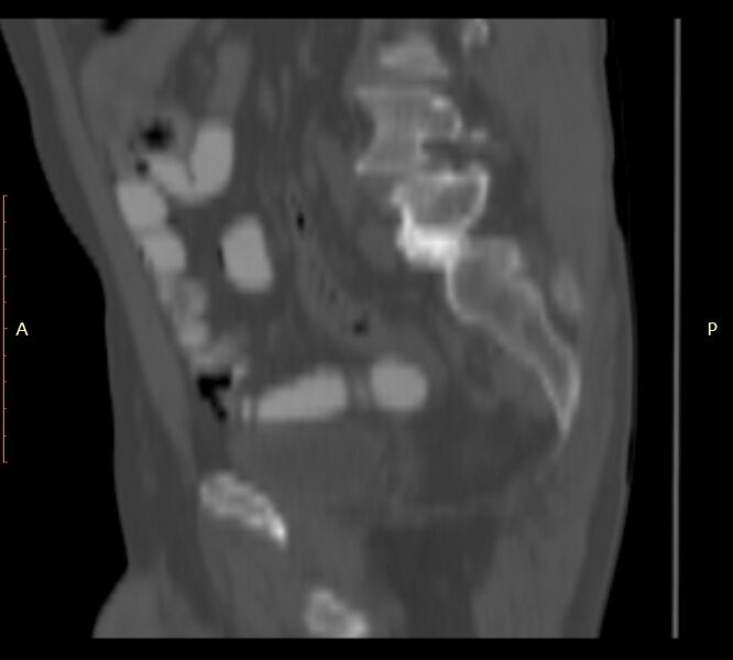 File:Bertolotti syndrome (Radiopaedia 58974-66235 Sagittal bone window 40).jpg