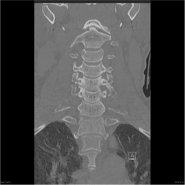 File:Bilateral cervical ribs (Radiopaedia 25868-26017 Coronal bone window 15).jpg