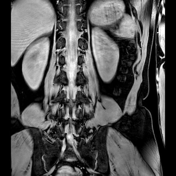 File:Bilateral conjoined nerve roots at different levels (Radiopaedia 73312-84063 B 33).jpg
