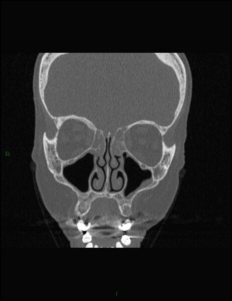 File:Bilateral frontal mucoceles (Radiopaedia 82352-96454 Coronal 132).jpg