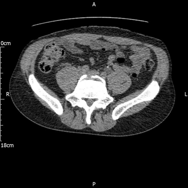 File:Bilateral medullary nephrocalcinosis with ureteric calculi (Radiopaedia 71269-81569 Axial non-contrast 86).jpg