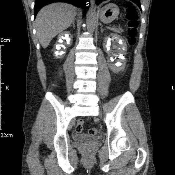 File:Bilateral medullary nephrocalcinosis with ureteric calculi (Radiopaedia 71269-81569 Coronal non-contrast 46).jpg