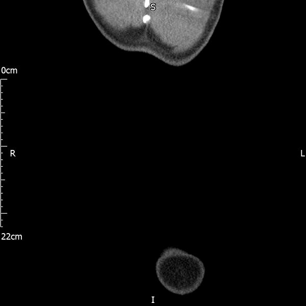 File:Bilateral medullary nephrocalcinosis with ureteric calculi (Radiopaedia 71269-81569 Coronal non-contrast 79).jpg