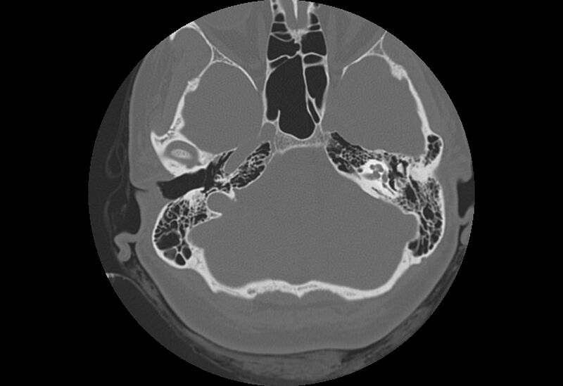 File:Bilateral otospongiosis (Radiopaedia 35447-36940 B 24).jpg