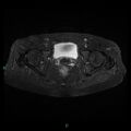 Bilateral ovarian fibroma (Radiopaedia 44568-48293 Axial STIR 22).jpg