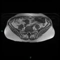 Bilateral ovarian fibroma (Radiopaedia 44568-48293 Axial T1 3).jpg