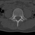 Bilateral pars defect (Radiopaedia 26691-26846 Axial bone window 28).jpg