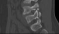 Bilateral pars defect (Radiopaedia 26691-26846 Sagittal bone window 41).jpg