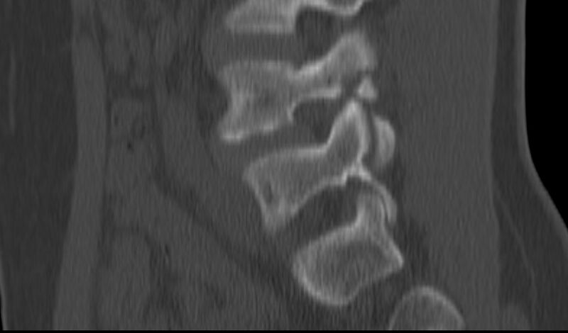 File:Bilateral pars defect (Radiopaedia 26691-26846 Sagittal bone window 41).jpg