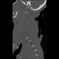 Bilateral perched facets with cord injury (Radiopaedia 45587-49713 Sagittal bone window 6).jpg