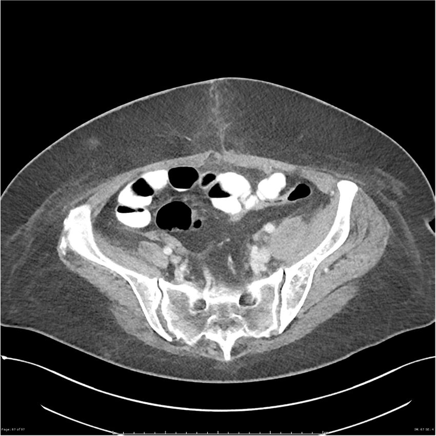 Bilateral psoas hematomas (Radiopaedia 24057-24279 A 67).jpg