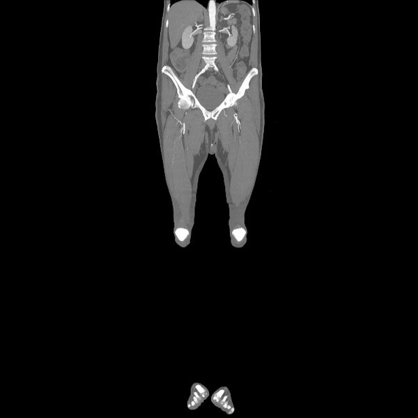 File:Bilateral superficial femoral arterial occlusion (Radiopaedia 25682-25857 Coronal MIP 13).jpg