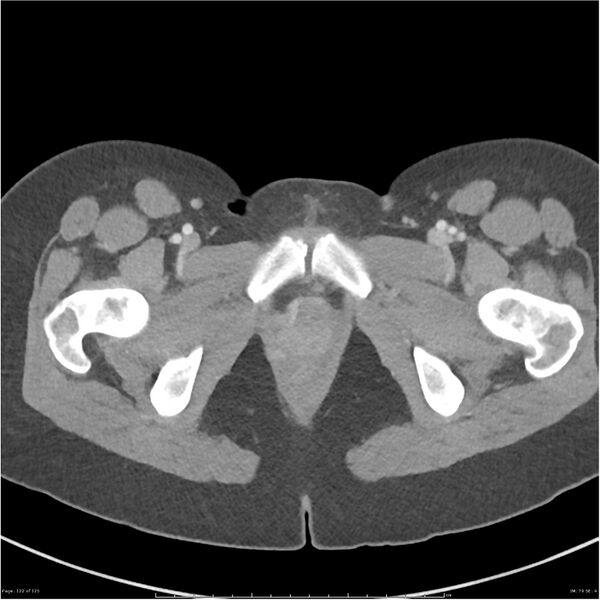 File:Bilateral ureteritis and cystitis (Radiopaedia 25340-25594 A 79).jpg
