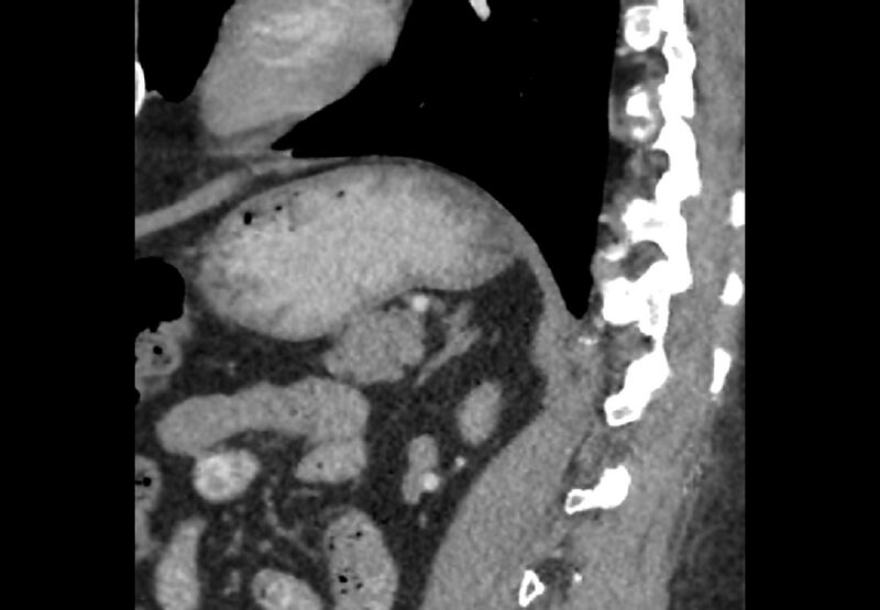 File:Bilateral urolithiasis with incidentally detected splenic artery aneurysm and left inferior vena cava (Radiopaedia 44467-48127 Ob. Sag. C+ Art. 34).jpg