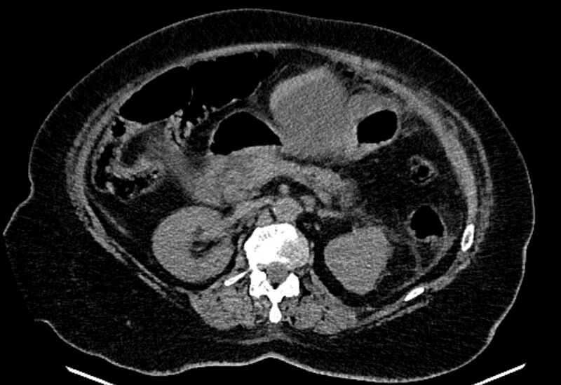 File:Biliary pancreatitis (Radiopaedia 72289-82823 Axial non-contrast 107).jpg