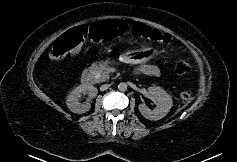File:Biliary pancreatitis (Radiopaedia 72289-82823 Axial non-contrast 122).jpg