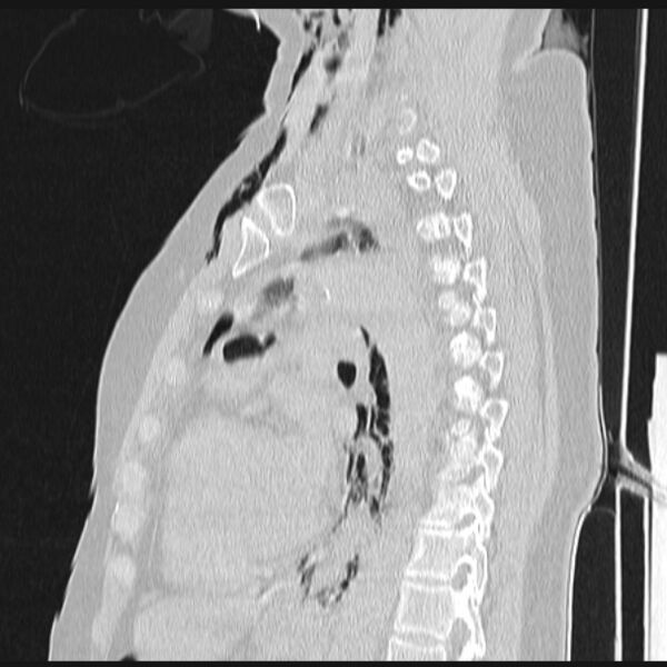 File:Boerhaave syndrome (Radiopaedia 45644-49799 Sagittal lung window 49).jpg