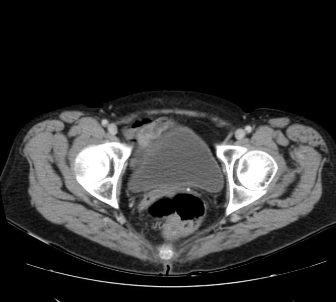 File:Bosniak renal cyst - type IV (Radiopaedia 22929-22953 C 64).jpg