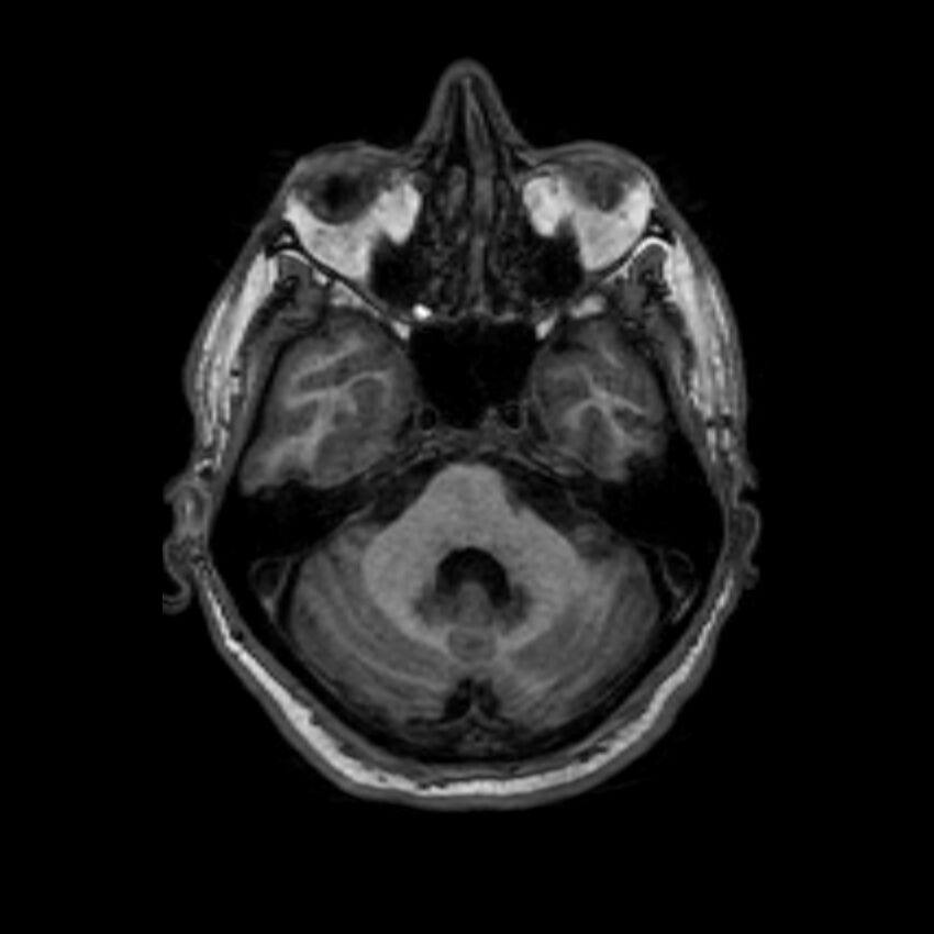 Brain abscess complicated by intraventricular rupture and ventriculitis (Radiopaedia 82434-96577 Axial T1 14).jpg