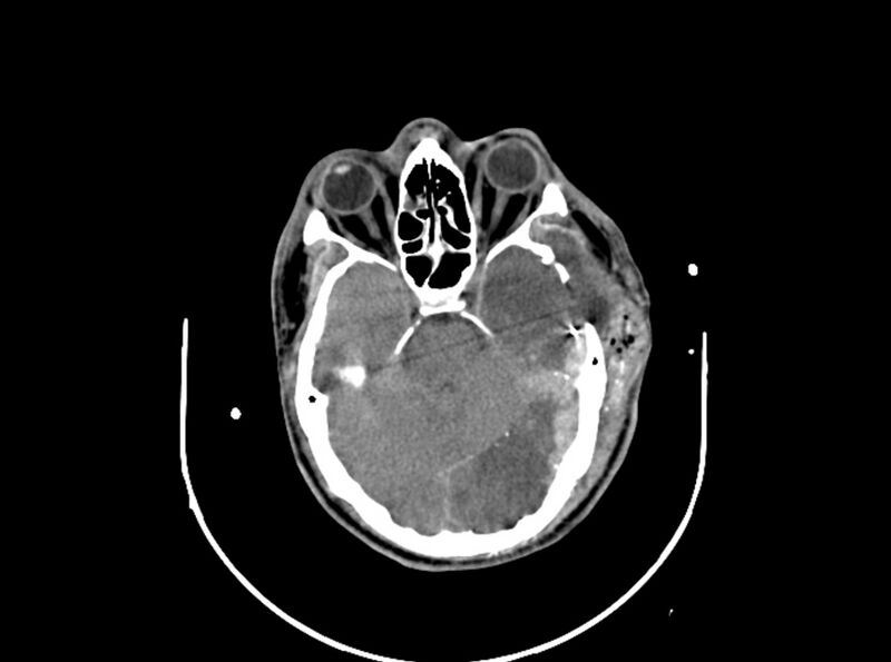 File:Brain injury by firearm projectile (Radiopaedia 82068-96087 B 78).jpg