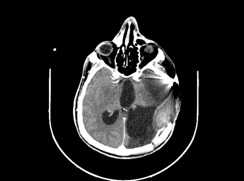 File:Brain injury by firearm projectile (Radiopaedia 82068-96088 B 121).jpg