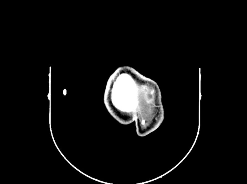 File:Brain injury by firearm projectile (Radiopaedia 82068-96088 B 203).jpg