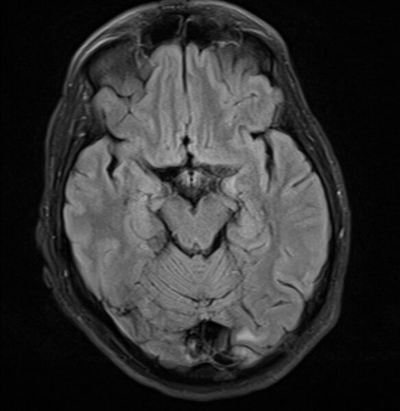 File:Brain metastases - lung cancer primary (Radiopaedia 75060-86115 Axial FLAIR 11).jpg