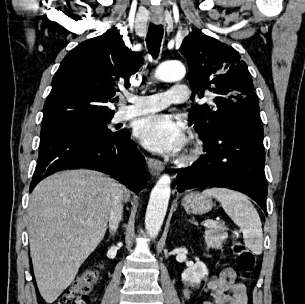 File:Brain metastases - lung cancer primary (Radiopaedia 75060-86116 C+ arterial phase 35).jpg