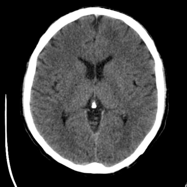 File:Brain metastases from lung cancer (Radiopaedia 24480-24781 Axial non-contrast 25).jpg