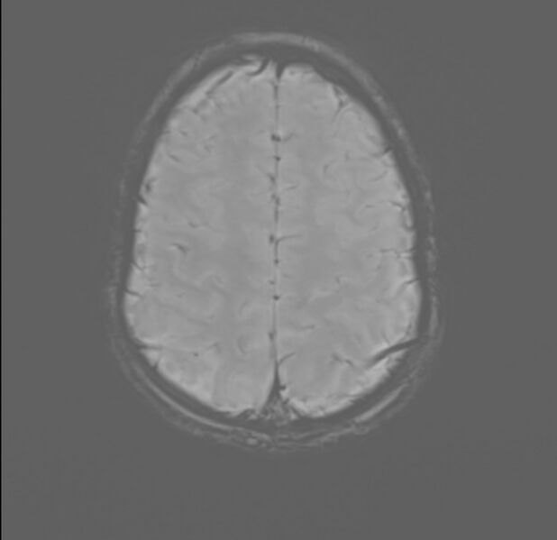File:Brainstem glioma (Radiopaedia 70548-80674 Axial SWI 52).jpg