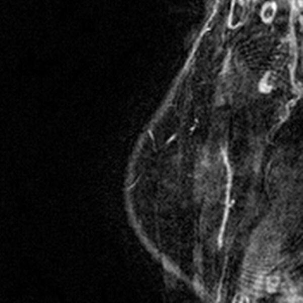 File:Breast implants - MRI (Radiopaedia 26864-27035 Sagittal T2 120).jpg