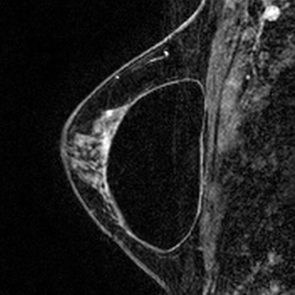 File:Breast implants - MRI (Radiopaedia 26864-27035 Sagittal T2 21).jpg
