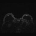 Breast implants - MRI (Radiopaedia 26864-27035 T2 SPAIR 17).jpg