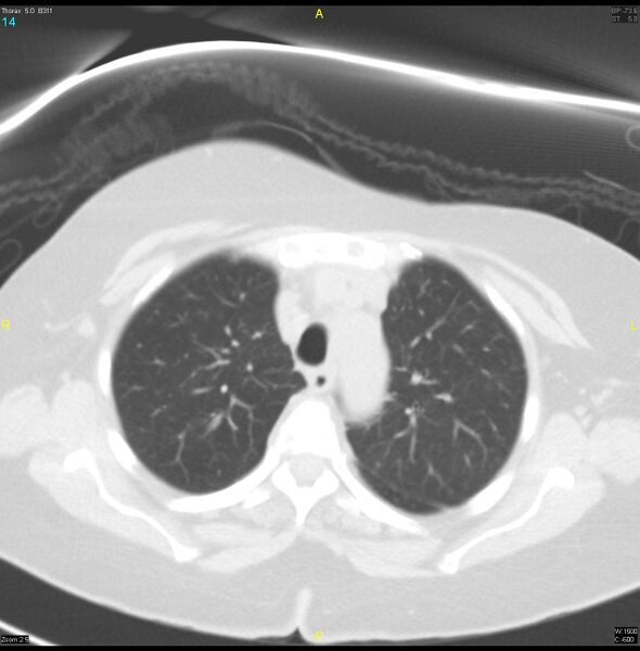 File:Breast primary with lung and bone metastases (Radiopaedia 40620-43228 Axial lung window 14).jpg