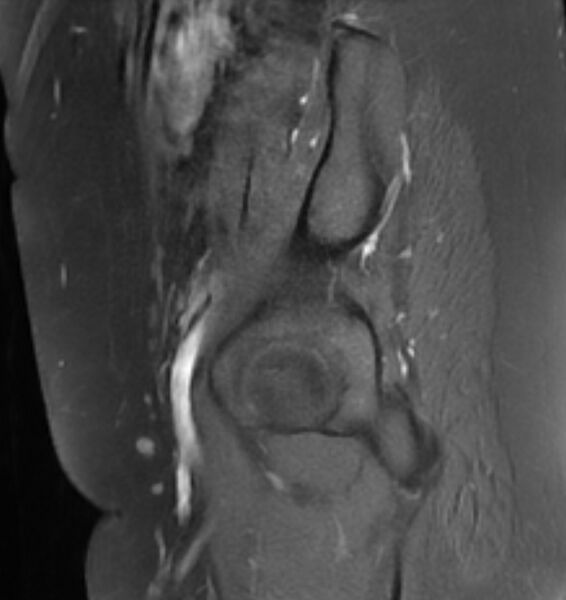 File:Broad ligament leiomyoma (Radiopaedia 81634-95516 G 27).jpg