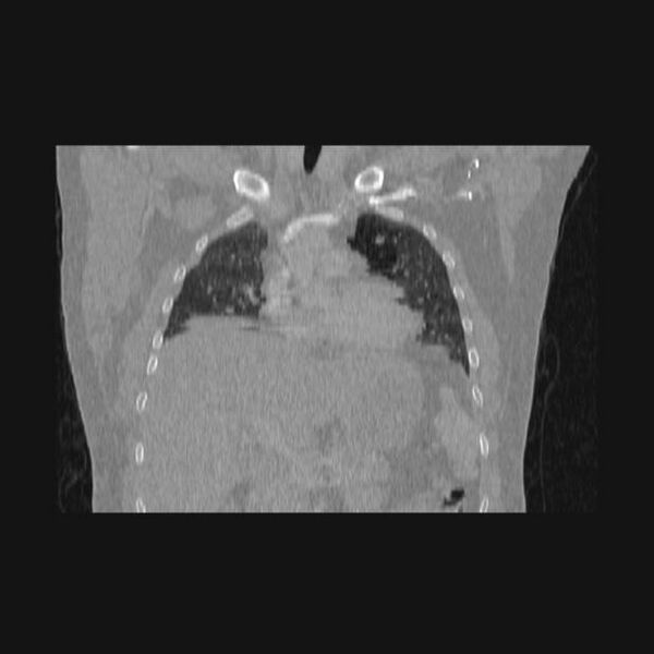 File:Bronchial atresia (Radiopaedia 60685-68439 Coronal lung window 46).jpg