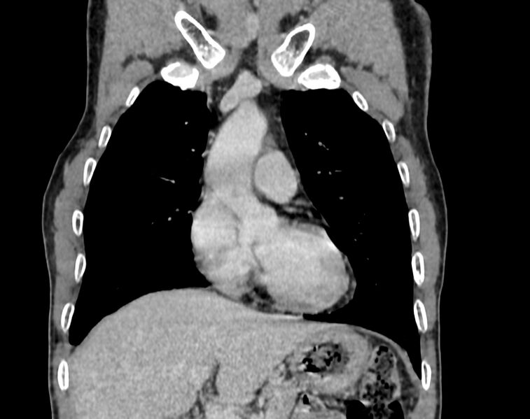 File:Bronchogenic carcinoma with superior vena cava syndrome (Radiopaedia 36497-38054 Coronal C+ delayed 5).jpg