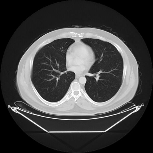 File:Bronchogenic carcinoma with upper lobe collapse (Radiopaedia 29297-29726 Axial lung window 20).jpg