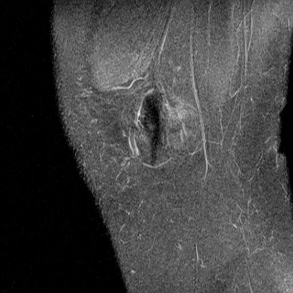File:Bucket handle tear - medial meniscus (Radiopaedia 79028-91942 Sagittal PD fat sat 24).jpg