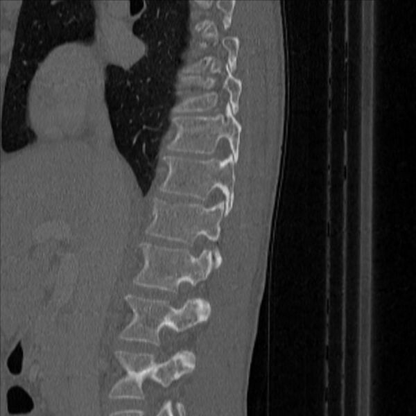 File:Bulging of paraspinal line in traumatic thoracal spinal compression fracture (Radiopaedia 29221-35872 Sagittal bone window 10).jpg