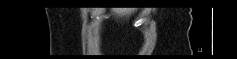 File:Buried bumper syndrome - gastrostomy tube (Radiopaedia 63843-72575 Sagittal Inject 113).jpg