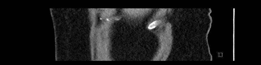 Buried bumper syndrome - gastrostomy tube (Radiopaedia 63843-72575 Sagittal Inject 113).jpg