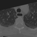 C2 fracture with vertebral artery dissection (Radiopaedia 37378-39199 Axial bone window 59).png