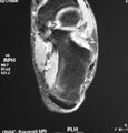 Calcaneal stress fracture (Radiopaedia 11969-45924 Axial T2 fat sat 1).jpg