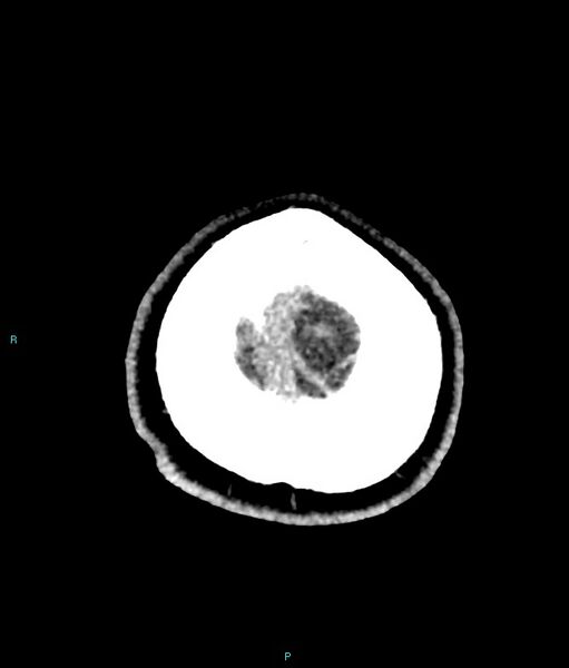 File:Calcified cerebral emboli from left ventricular thrombus (Radiopaedia 84420-99758 Axial non-contrast 7).jpg