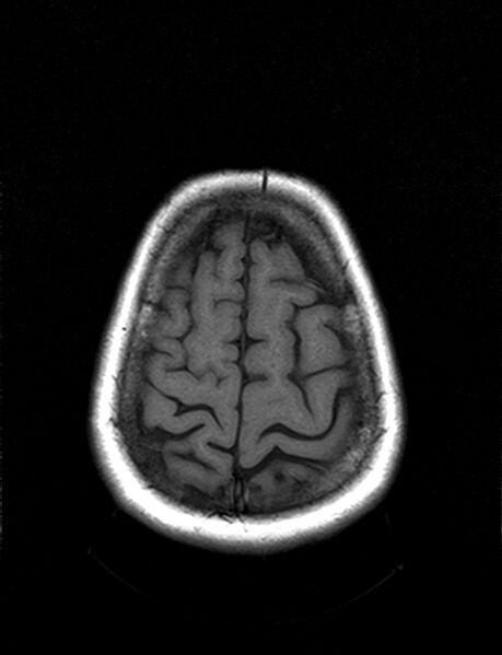 File:Calcified cerebral hydatid cyst (Radiopaedia 65603-74699 Axial T1 20).jpg