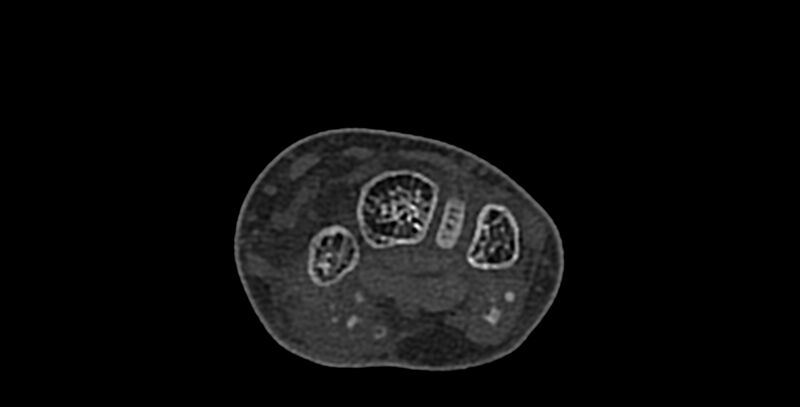 File:Calcifying aponeurotic fibroma (Radiopaedia 88423-105064 Axial bone window 74).jpg