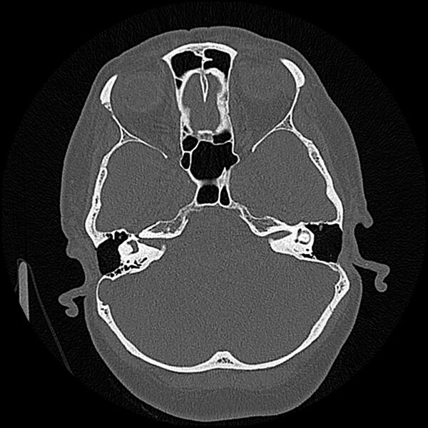 File:Canal up mastoidectomy (Radiopaedia 78108-90638 Axial bone window 85).jpg