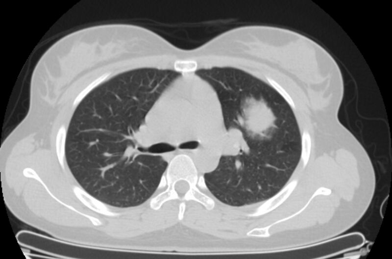 File:Cannonball metastases - uterine choriocarcinoma (Radiopaedia 70137-80173 Axial lung window 30).jpg